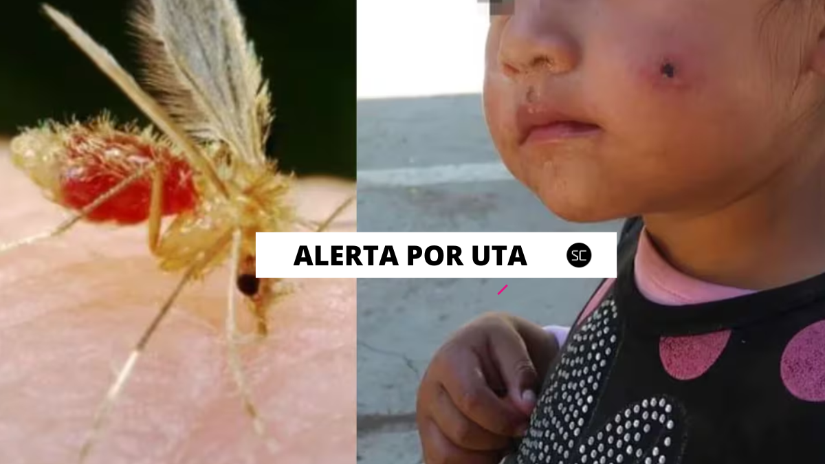La UTA o Leishmaniasis en Perú sigue generando gran preocupación, pues reportan más casos de esta enfermedad que "come" la piel.